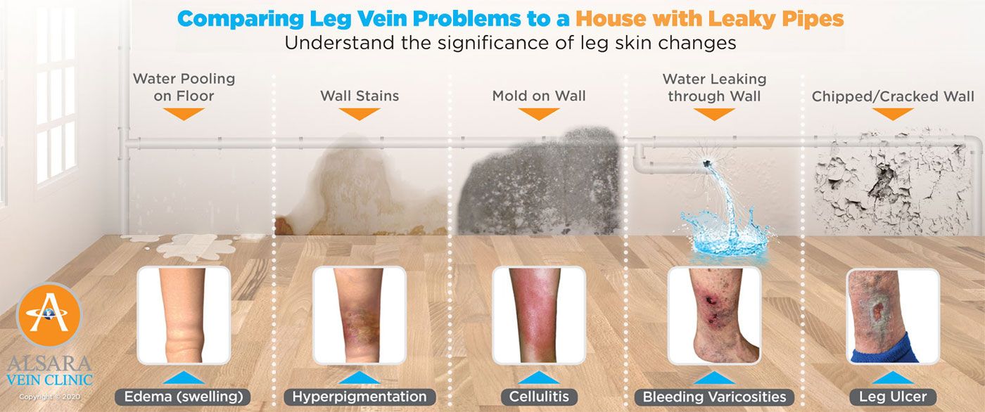 Restless Legs and Leg Cramps - Alsara Vein Clinic